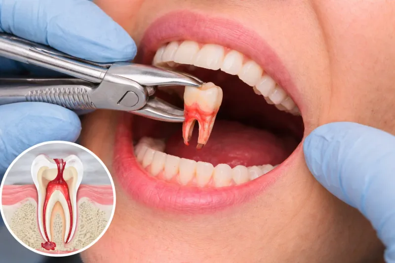 Tooth extraction at Carewell Dental Sentul KL
